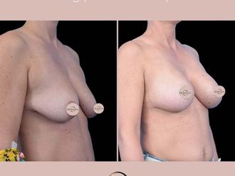 Mastopeksja przed i po - 876720