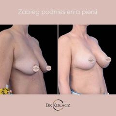 Podniesienie i powiększenie piersi u pacjentki Dr n. med. Szymona Kołacza