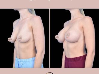 Powiększanie biustu przed i po - 876877