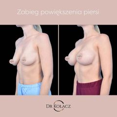 Powiększenie piersi metodą podpowięziową przy użyciu implantów silikonowych