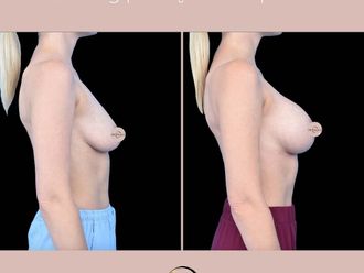 Powiększanie biustu przed i po - 876878