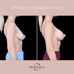 Powiększenie piersi metodą podpowięziową przy użyciu implantów silikonowych