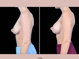 Powiększanie biustu przed i po - 876879