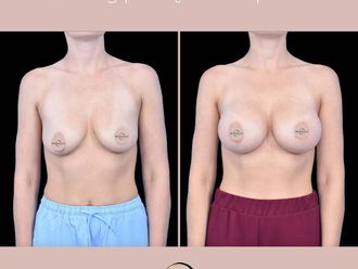 Powiększanie biustu przed i po - 876880