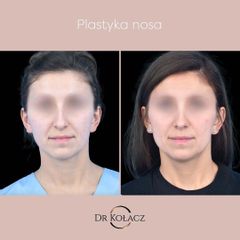 Plastyka nosa - Dr n. med. Szymon Kołacz