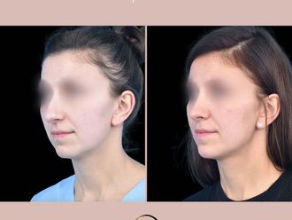 Korekta nosa przed i po - 877093