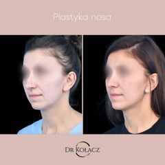 Plastyka nosa - Dr n. med. Szymon Kołacz