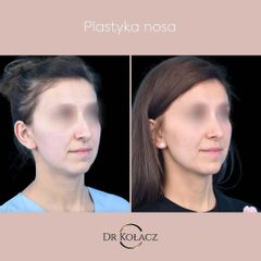 Plastyka nosa - Dr n. med. Szymon Kołacz