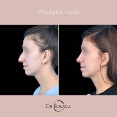 Plastyka nosa - Dr n. med. Szymon Kołacz