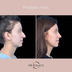 Plastyka nosa - Dr n. med. Szymon Kołacz