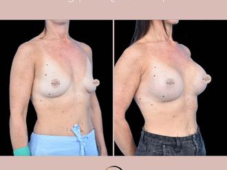 Powiększanie biustu przed i po - 877171