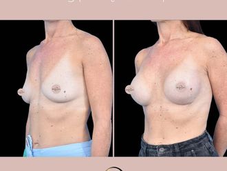 Powiększanie biustu przed i po - 877172