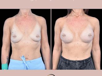 Powiększanie biustu przed i po - 877173
