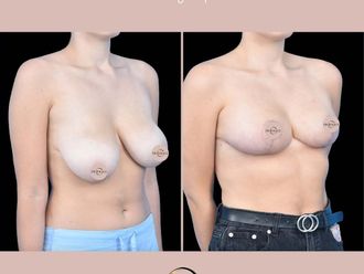 Zmniejszenie biustu przed i po - 877277