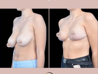 Zmniejszenie biustu przed i po - 877278