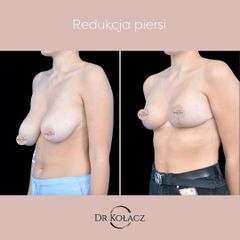 Redukcja piersi przy asymetrii - Dr n. med. Szymon Kołacz