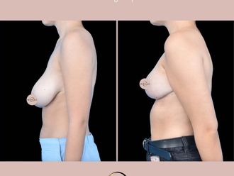 Zmniejszenie biustu przed i po - 877279
