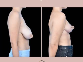 Zmniejszenie biustu przed i po - 877280