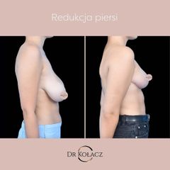 Redukcja piersi przy asymetrii - Dr n. med. Szymon Kołacz