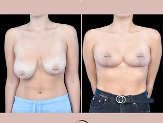 Zmniejszenie biustu przed i po - 877281