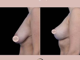 Zmniejszenie biustu przed i po - 877576