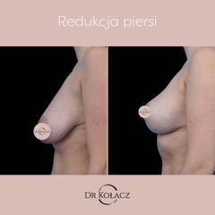 Redukcja piersi - Dr n. med. Szymon Kołacz