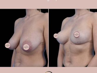 Zmniejszenie biustu przed i po - 877577