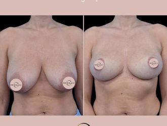 Zmniejszenie biustu przed i po - 877578