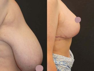 Zmniejszenie biustu przed i po - 877802