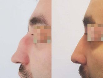 Korekta nosa przed i po - 878330