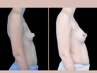 Powiększanie biustu przed i po - 878599