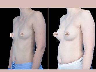 Powiększanie biustu przed i po - 878600