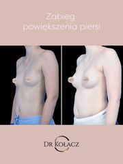 Powiększenie piersi metodą podpowięziową - Dr n. med. Szymon Kołacz