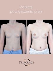 Powiększenie piersi metodą podpowięziową - Dr n. med. Szymon Kołacz