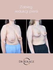 Redukcja piersi - Dr n. med. Szymon Kołacz