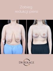 Redukcja piersi - Dr n. med. Szymon Kołacz