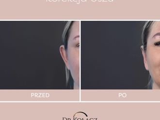 Korekcja uszu przed i po - 880722