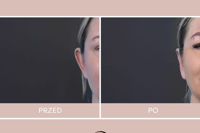 Korekcja uszu przed i po - 880722