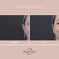 Korekcja uszu Dr n. med. Szymon Kołacz