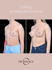Powiększenie piersi metodą podpowięziową - Dr n. med. Szymon Kołacz