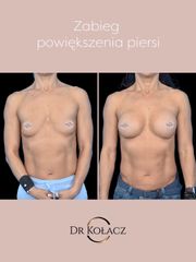 Powiększenie piersi metodą podpowięziową, implanty o pojemności 335ml