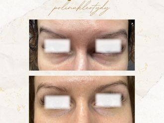 Anti-aging przed i po - 873989