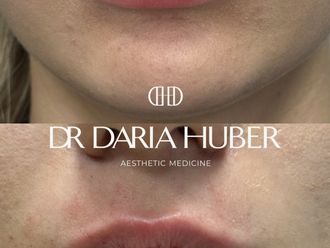 Powiększanie ust przed i po - 877422