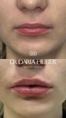 Modelowanie ust kwasem hialuronowym