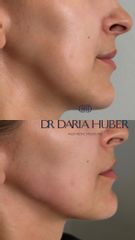 Modelowanie żuchwy kwasem hialuronowym