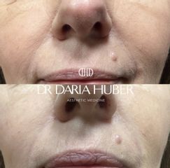 Modelowanie ust kwasem hialuronowym