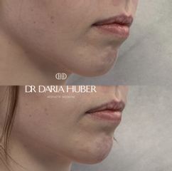 Modelowanie brody kwasem hialuronowym