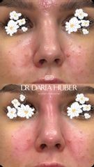 Modelowanie nosa kwasem hialuronowym