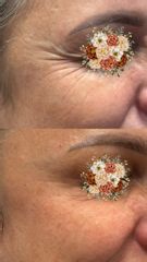 Toksyna botulinowa „kurze łapki”