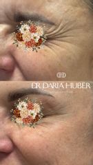 Toksyna botulinowa - „kurze łapki”